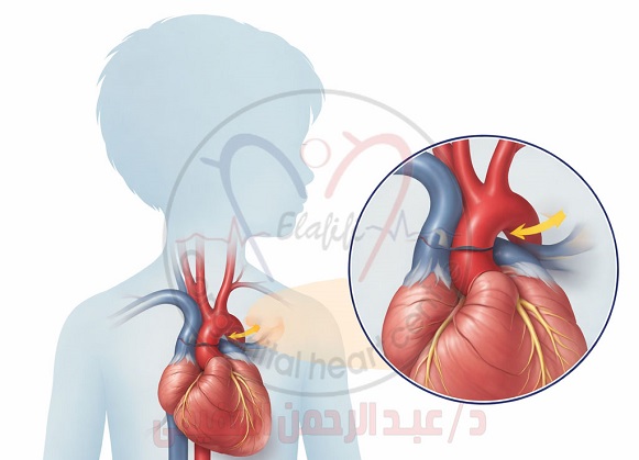 ضيق الشريان الأورطي